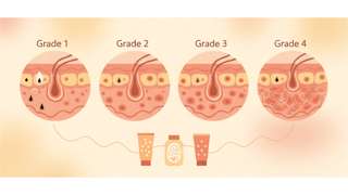青春痘的症状分四级，一文读懂对付青春痘有什么药膏更管用